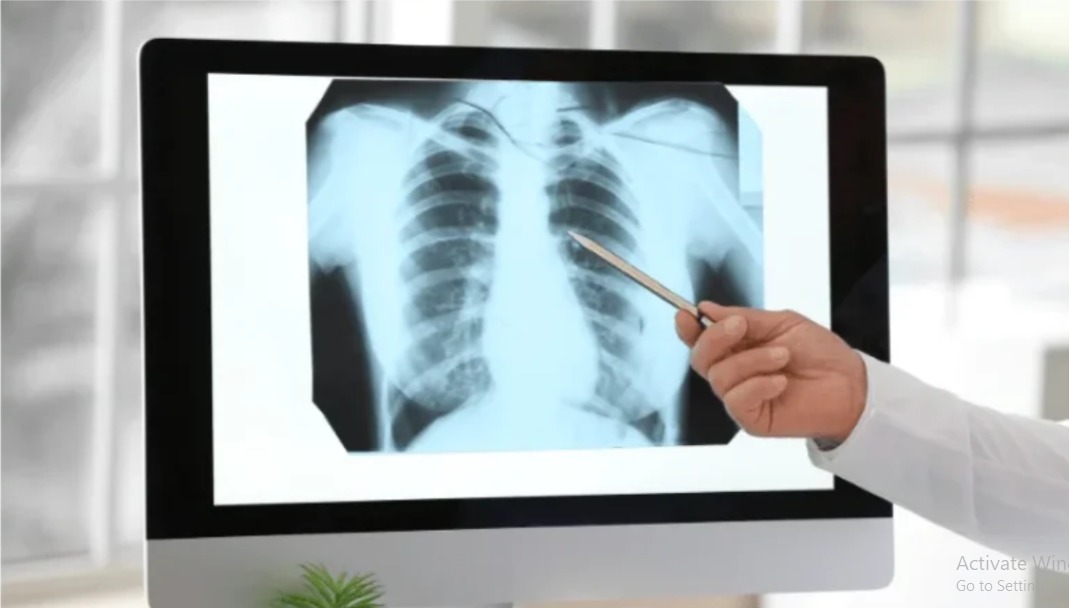 Tuberculosis & Respiratory